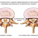 cervical spinal stenosis