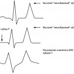 Typical ECG changes in patients with hyperkalemia