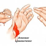types of bleeding