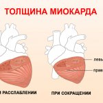 Ventricular myocardial thickness