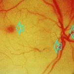 Thrombosis of the central retinal artery diagnostics