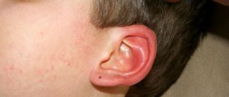 A child has an ear infection