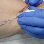 Removal of spider veins using microsclerotherapy