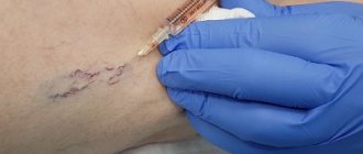 Removal of spider veins using microsclerotherapy