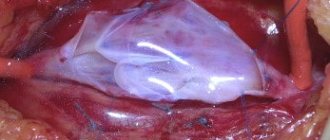 Вальвулопластика - восстановление клапанов глубоких вен