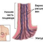 Varicose veins of the esophagus
