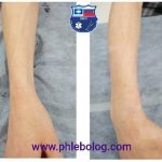 Veins of the forearm before (left) and after (right) sclerotherapy