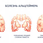 вида болезни альцгеймера
