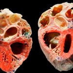 The effects of alcohol on the heart - Site