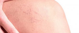All about varicose veins: what to look for if the veins become visible