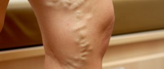 Veins protrude from the legs - causes and treatment
