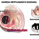 mitral valve replacement