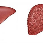 Healthy liver and cirrhosis