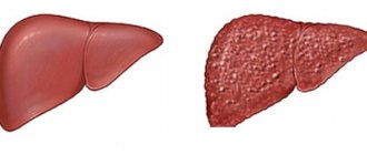 Healthy liver and cirrhosis